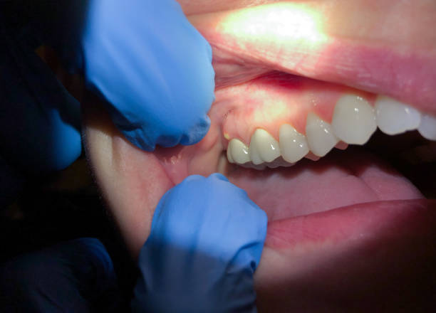 Best Dental Abscess Treatment in Woodruff, SC