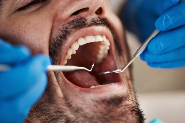 Best Emergency Wisdom Tooth Extraction in Woodruff, SC
